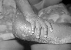Le Monkeypox déclarée une urgence de santé publique de portée internationale (OMS)